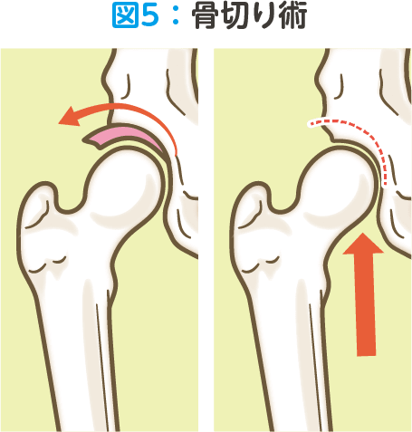 図4：心房細動カテーテル治療