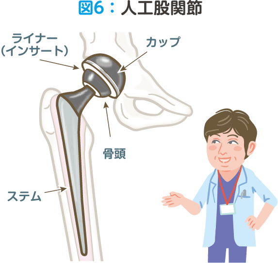 図6：人工股関節