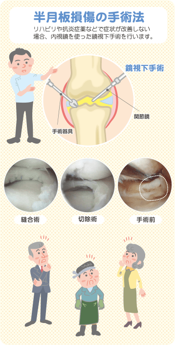 リハビリ 半月 板 損傷