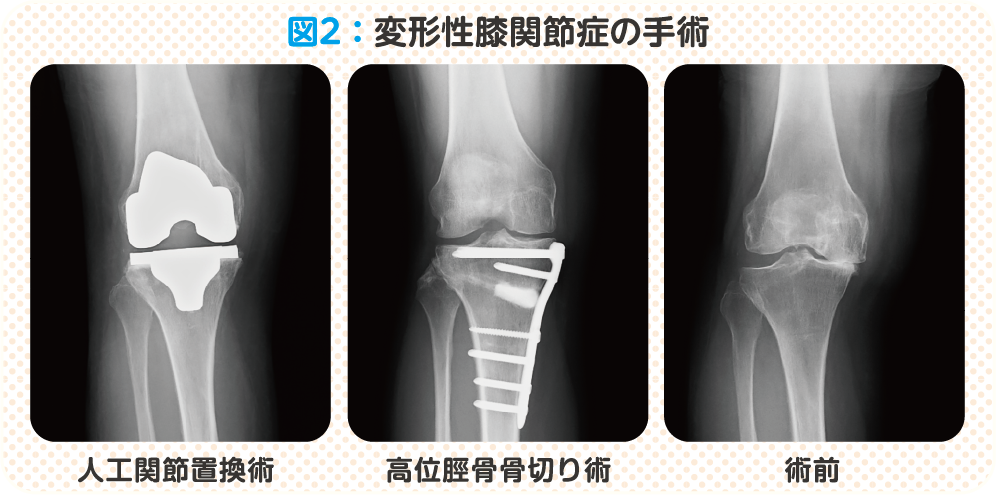 図2：変形性膝関節症の手術